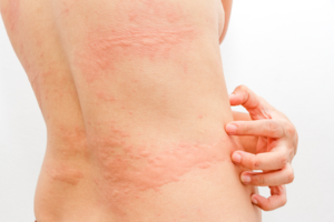 urticaria