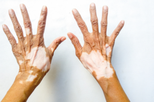 vitiligo